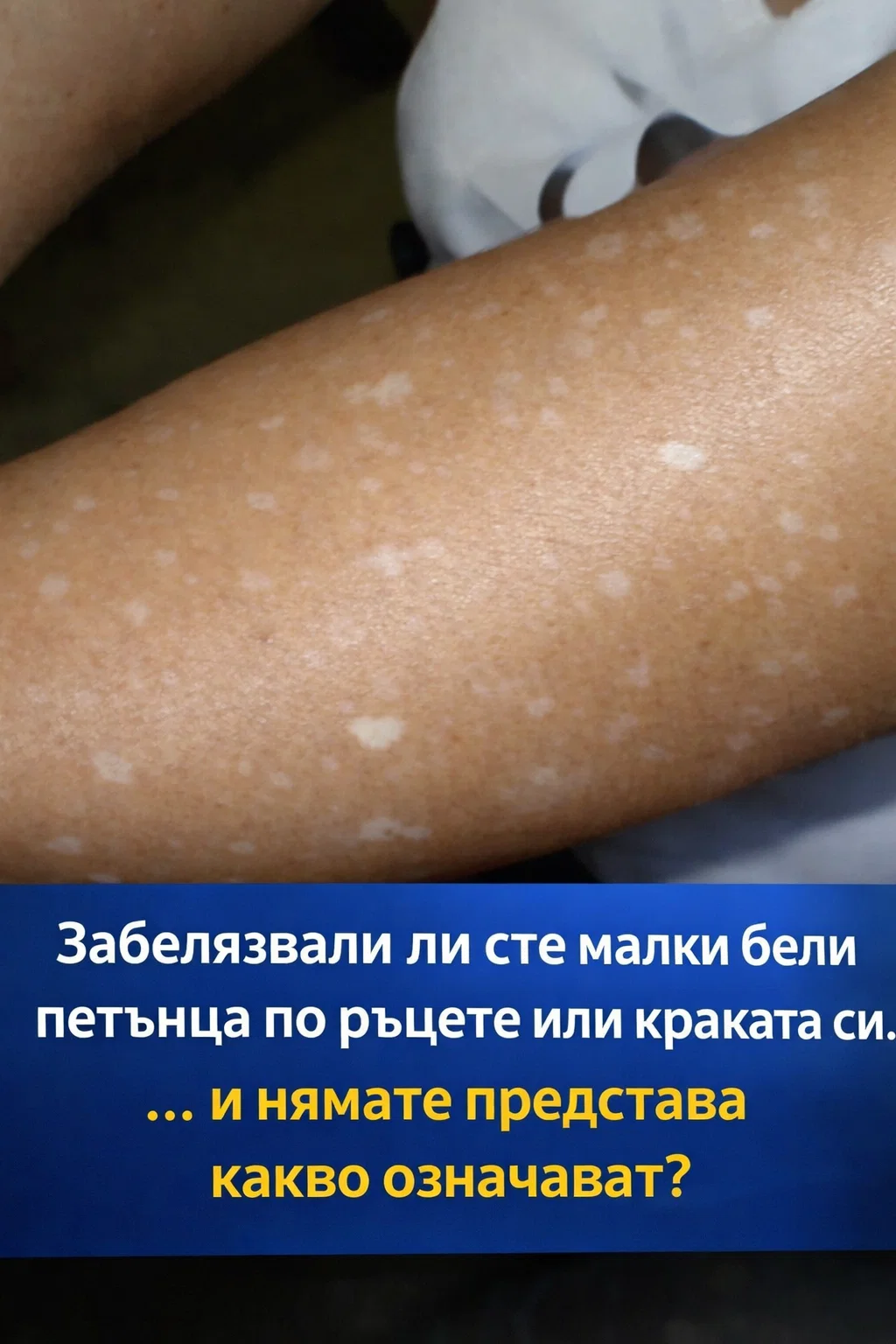 Забелязвали ли сте по ръцете или краката си малки бели петънца… и се чудите какво може да означават? Ето какво споделя специалист по темата. 👇 3