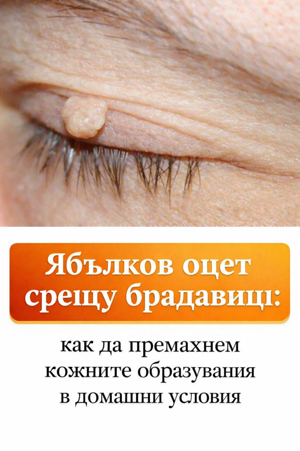 Ябълков оцет срещу брадавици: как да се справим с кожните образувания у дома 3