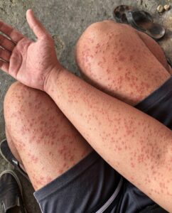 Пренощувах няколко дни в стария апартамент на приятел и забелязах по кожата си тези странни мехури. Какво може да е това? 2 677249634 857268477410841 854517