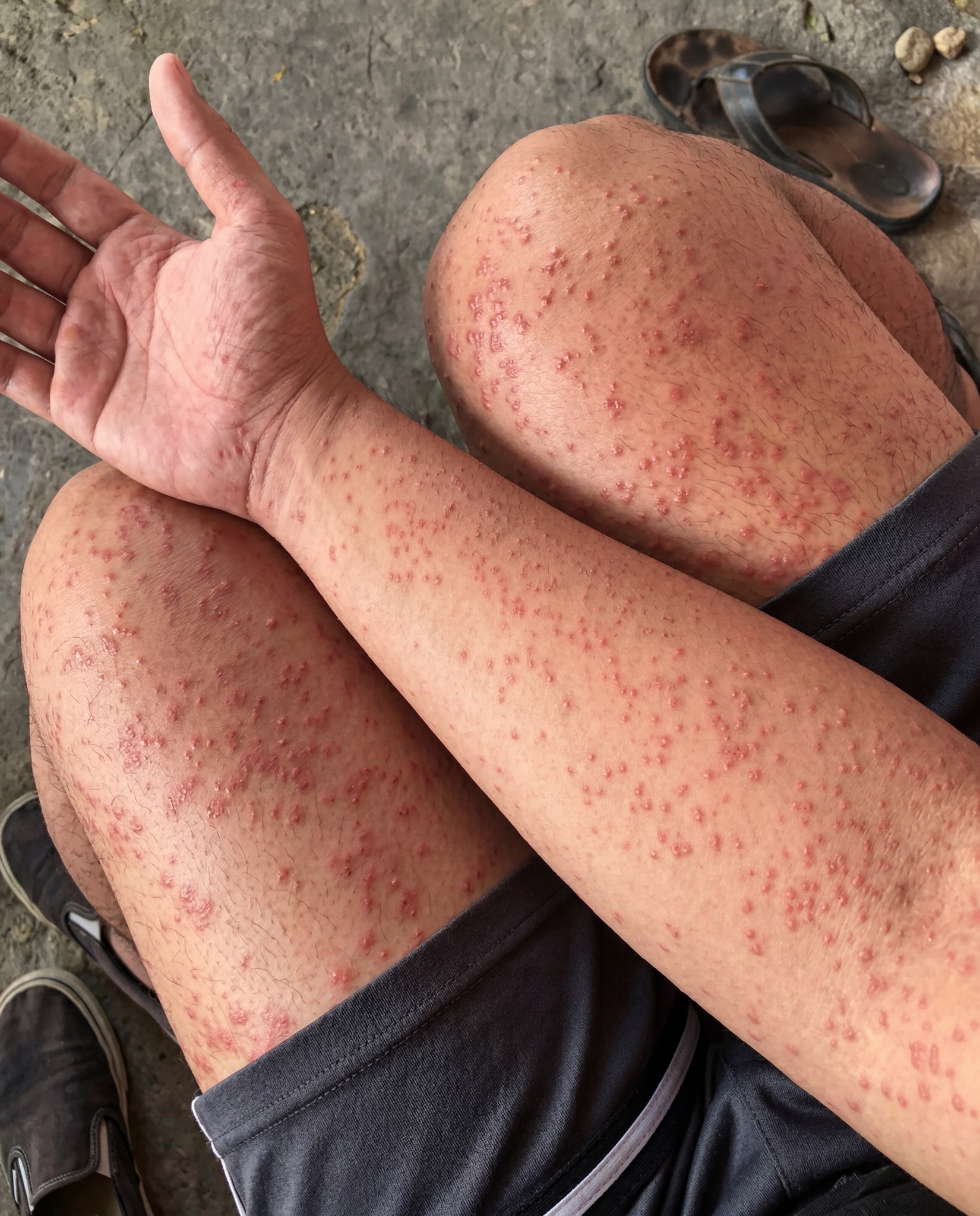 Пренощувах няколко дни в стария апартамент на приятел и забелязах по кожата си тези странни мехури. Какво може да е това? 3 677249634 857268477410841 854517