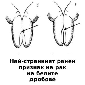 Най-странният ранен признак на рак на белите дробове. 20 lung cancer early sign bg 1080x1080 4lines