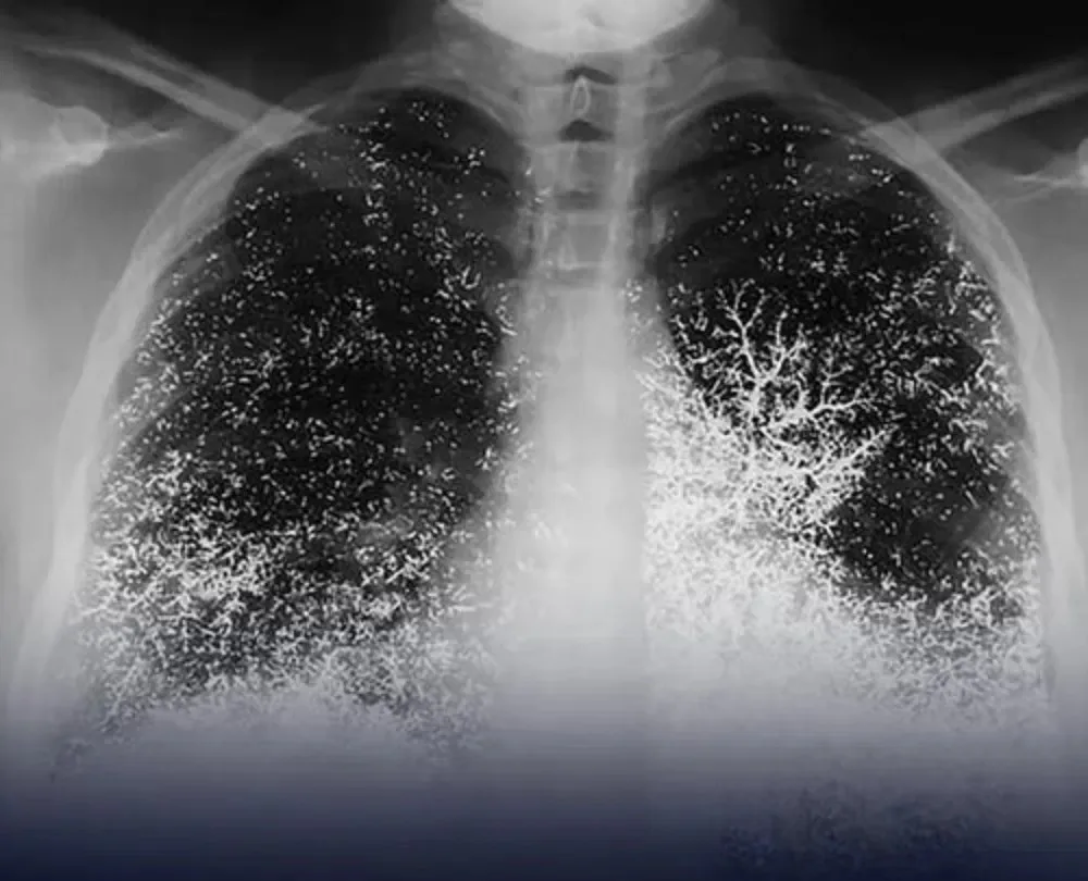 Шокиращ клиничен случай: 21-годишна жена си инжектира живак във вена 3 1000x1200 2025 05 30t162144.125.jpg