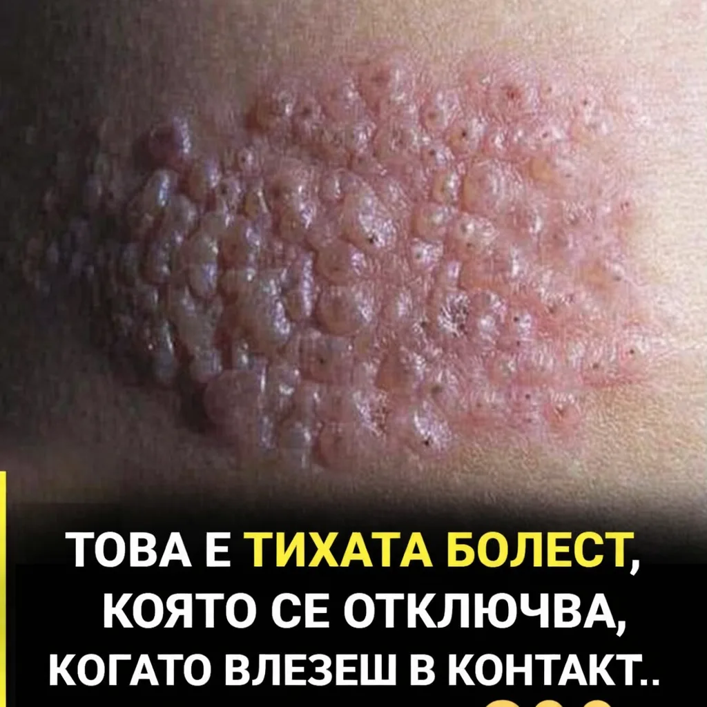 Това е тихата болест, която се отключва, когато влезеш в контакт с …😢👇👇 4 2ba09c79 1d46 438a a348 fcff3ece2816.png