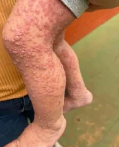 Цялото тяло го сърбеше, помисли, че е алергия… 8 498028574 714949680878267 2388120969219946886 n.jpg