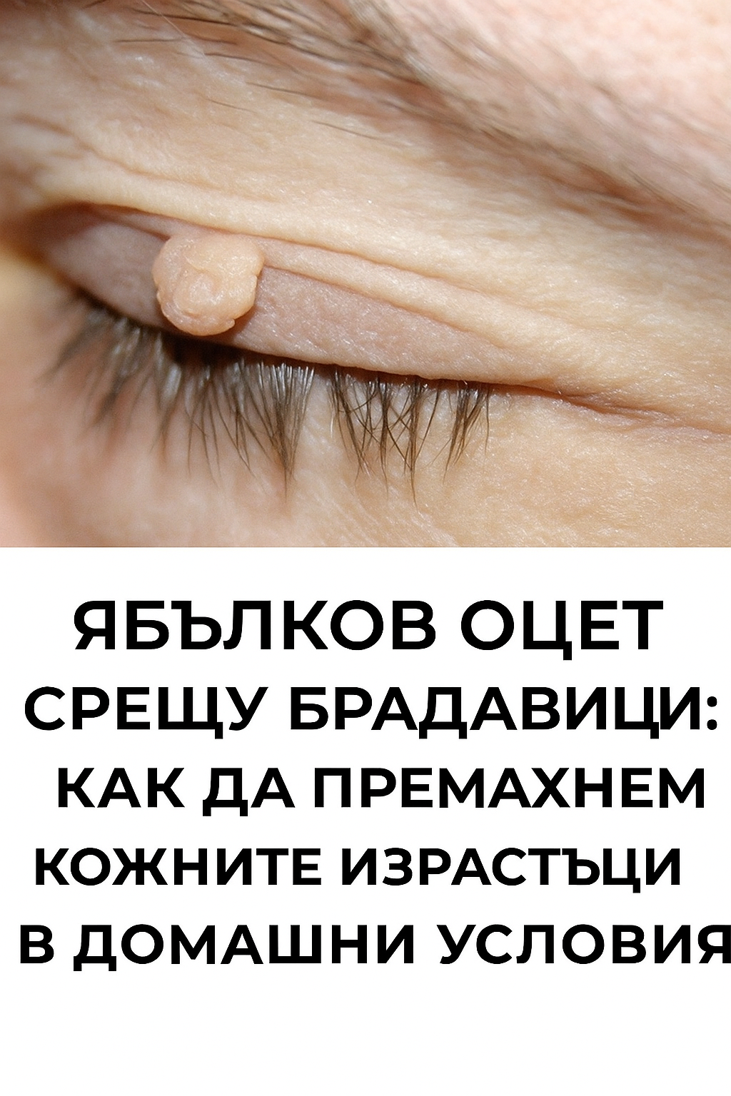 Ябълков оцет срещу брадавици: как да премахнете кожните образувания у дома 3 20251026 1456 yabalkov oczet i