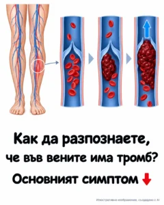 Как да разберете дали във вените има тромб? 👇 2 e9ab5c00 e48e 466f bf0b 5e6008c6